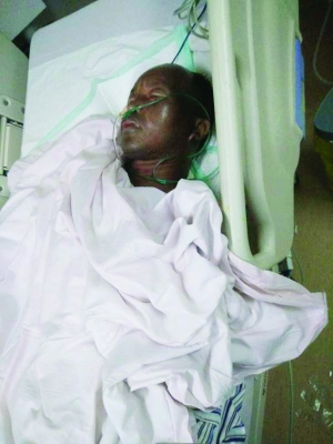 氫氣球爆炸致重度燒傷